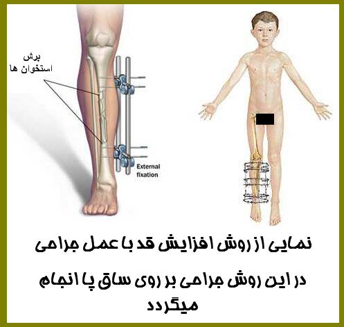 عمل جراحی <strong>افزایش</strong> <strong>قد</strong>